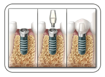 Dental Implant Phuket, We provide dentists services in Patong Beach.