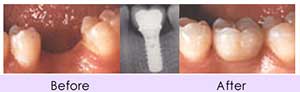 case implants