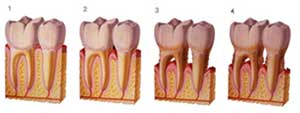 gum treatment