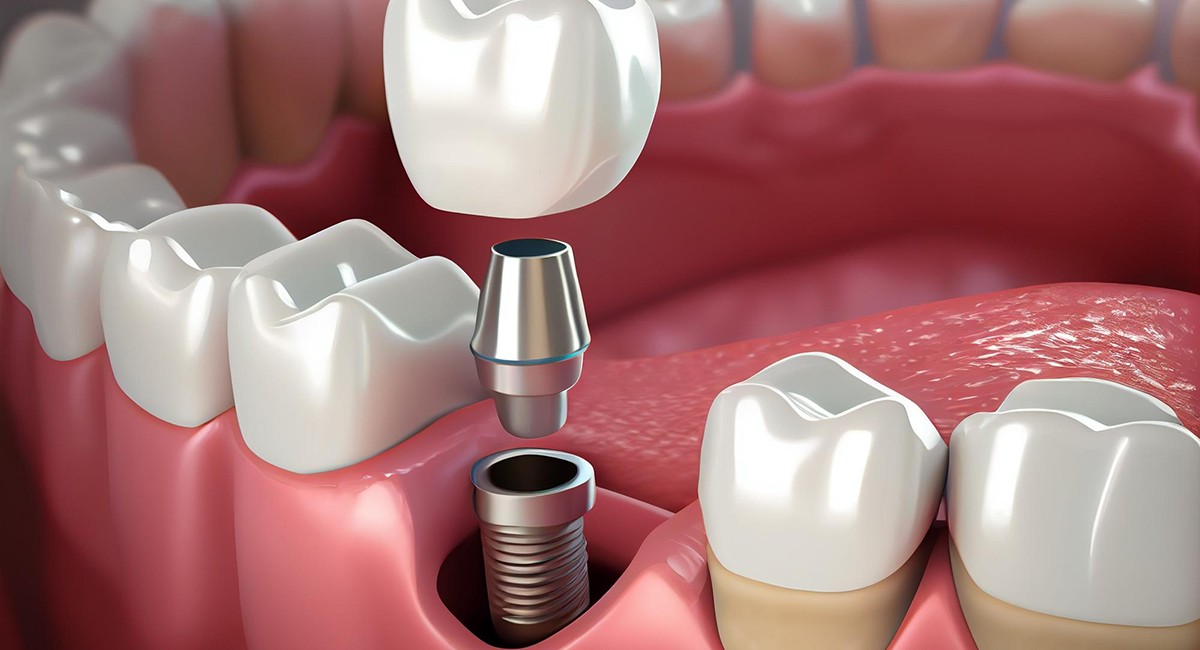 Immediate-Loading Dental Implants